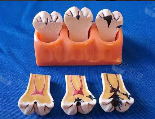 牙齿切面剖析图