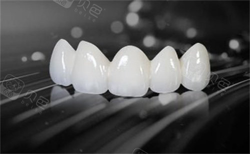 烤瓷牙实物图