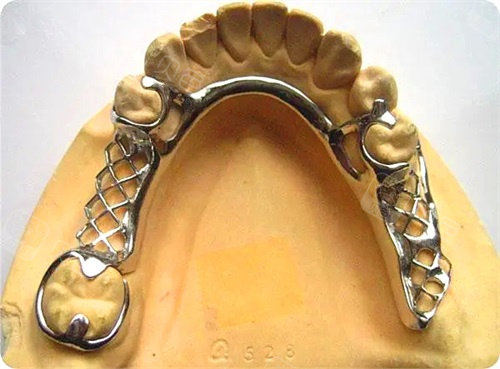 深入了解纯钛全口假牙的优缺点!是什么?有哪些?