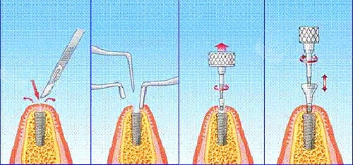 种植牙过程图