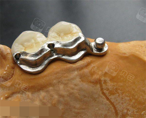 无挂钩假牙细节图