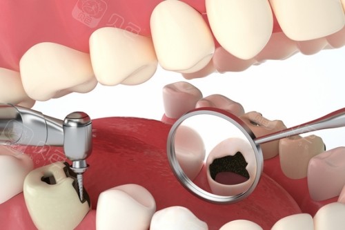 牙齿治疗检查图