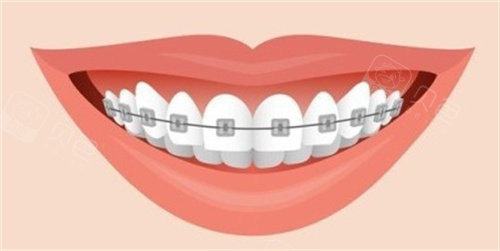 forestadent怎么读更新2023十大自锁托槽品牌排行榜!国产／进口品牌都包含!_https://www.jmylbn.com_新闻资讯_第1张