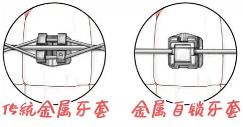 forestadent怎么读更新2023十大自锁托槽品牌排行榜!国产／进口品牌都包含!_https://www.jmylbn.com_新闻资讯_第2张