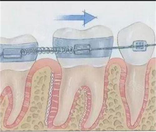 forestadent怎么读更新2023十大自锁托槽品牌排行榜!国产／进口品牌都包含!_https://www.jmylbn.com_新闻资讯_第3张