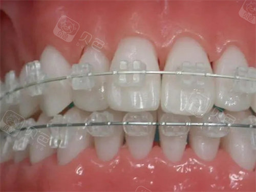 forestadent怎么读更新2023十大自锁托槽品牌排行榜!国产／进口品牌都包含!_https://www.jmylbn.com_新闻资讯_第5张