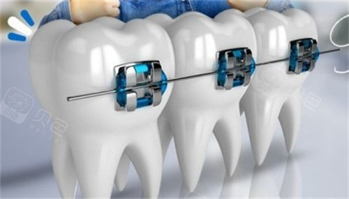 forestadent怎么读更新2023十大自锁托槽品牌排行榜!国产／进口品牌都包含!_https://www.jmylbn.com_新闻资讯_第6张