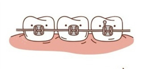 forestadent怎么读更新2023十大自锁托槽品牌排行榜!国产／进口品牌都包含!_https://www.jmylbn.com_新闻资讯_第7张