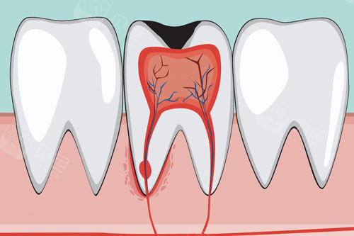 牙齿龋坏伤及神经