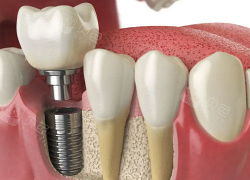 种植牙