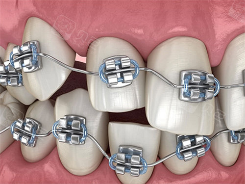 金属托槽矫正器