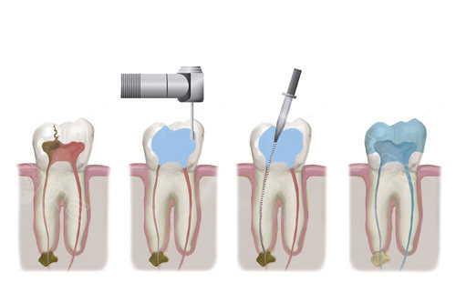 根管治疗步骤