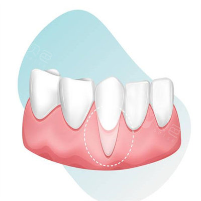 牙龈萎缩图