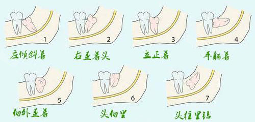 不同类型的阻生智齿示意图