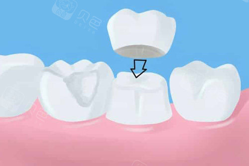 牙齿修复