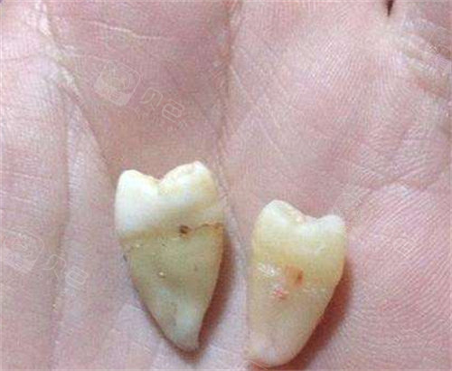 牙齿掉了实拍图