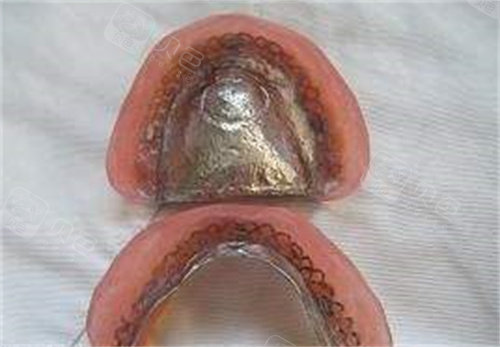 纯钛全口义齿图