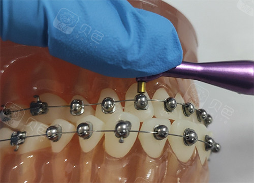看图片分析欧欧球托obrace托槽优势：国产自锁托槽价钱合适!(图7)