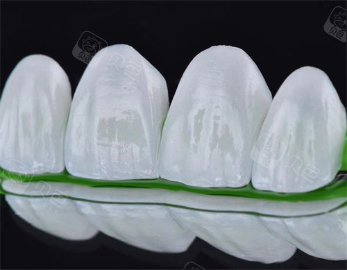 全瓷贴面示意图