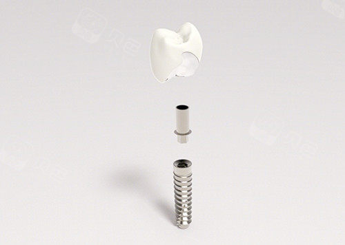 种植牙结构图示