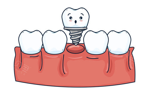 种植牙卡通图