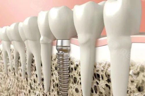 种植牙模拟展示图