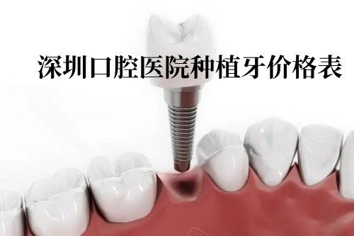 深圳口腔医院种植牙价格表