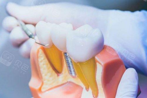 种植牙模型展示图