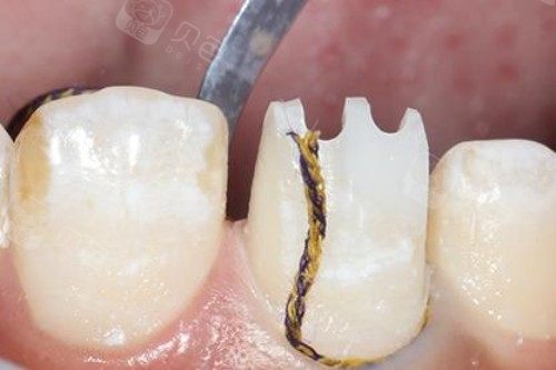 排龈线的作用真不小，附具体放置多长时间/多久取出合适！ - 沃牙网