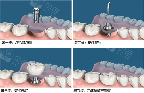 种植牙手术流程
