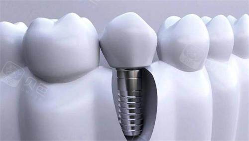 种植牙过程示意图
