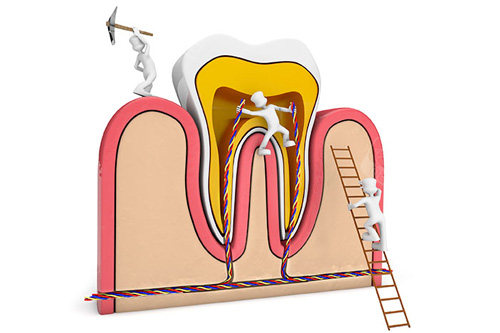 根管治疗卡通图