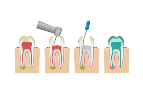根管治疗步骤图