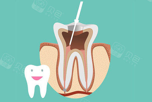 根管治疗卡通图