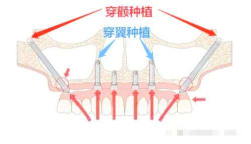 穿颧穿翼种植牙示意图