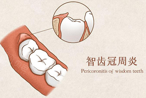 智齿冠周炎漫画示意图