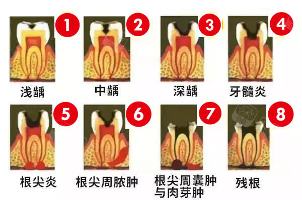 多年老牙医分享邻面龋早期症状 告诉你邻面龋齿已经有洞了怎么办 - 沃牙网
