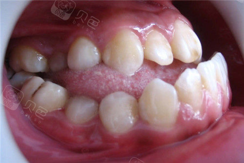 地包天牙齿照片