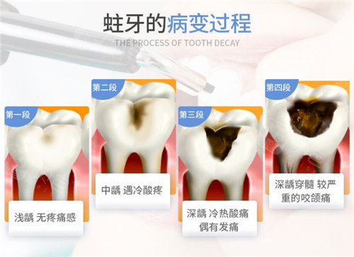 蛀牙的发展过程