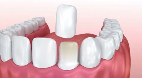 六腔是什么做完贴面牙齿发酸是什么原因？六个影响因素了解清楚才能对症进行治疗!_https://www.jmylbn.com_新闻资讯_第2张