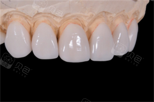 六腔是什么做完贴面牙齿发酸是什么原因？六个影响因素了解清楚才能对症进行治疗!_https://www.jmylbn.com_新闻资讯_第3张