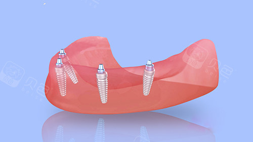 半口种植牙四颗植体植入漫画图