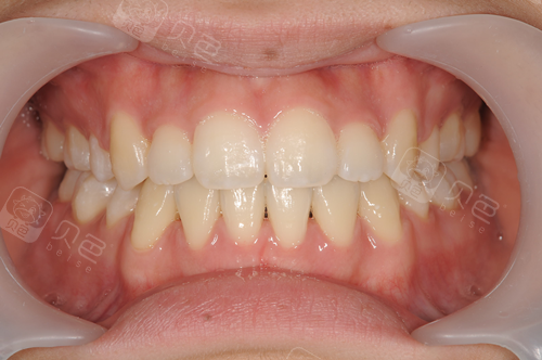 自测!怎么判断咬合正不正?