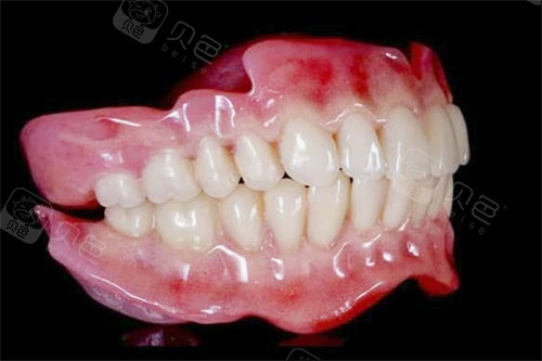 国产dsa有哪些品牌没看错!吸附性义齿有三种档次,品牌决定价格：DSA｜GS｜莱美｜BPS｜从1万到3万差异也不小_https://www.jmylbn.com_新闻资讯_第4张