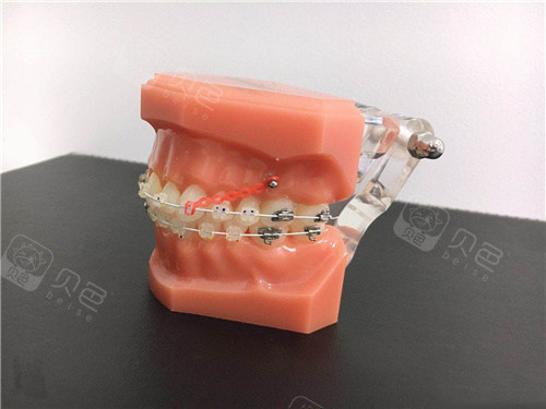 金属托槽矫正模型