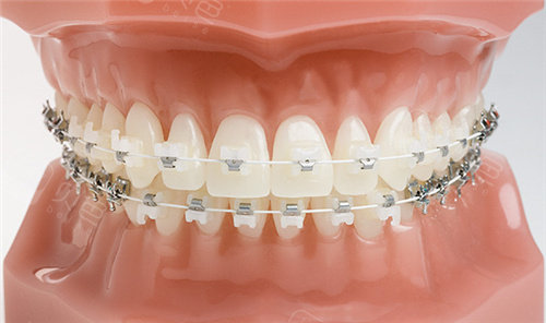 Ceramic-Braces-1