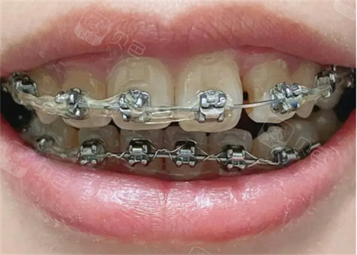 龅牙金属矫正图