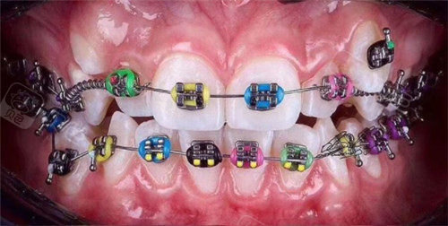 金属牙套细节照片