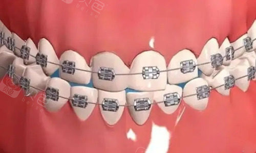 金属自锁托槽矫正