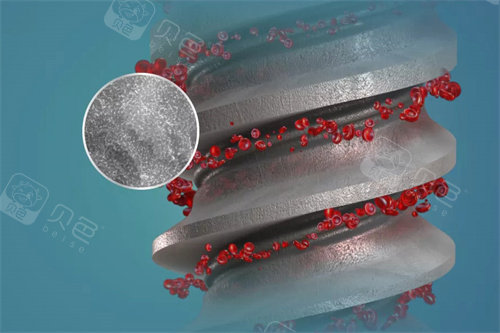 卡瓦口腔怎么购买德国卡瓦ABT种植体怎么样？一般多少钱？材质稳定／型号多样／独特设计／单颗植体9k+_https://www.jmylbn.com_新闻资讯_第3张